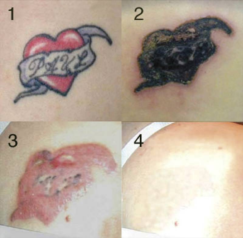 Tattoo Removal Places In Chicago Removal | affordable tattoo removal